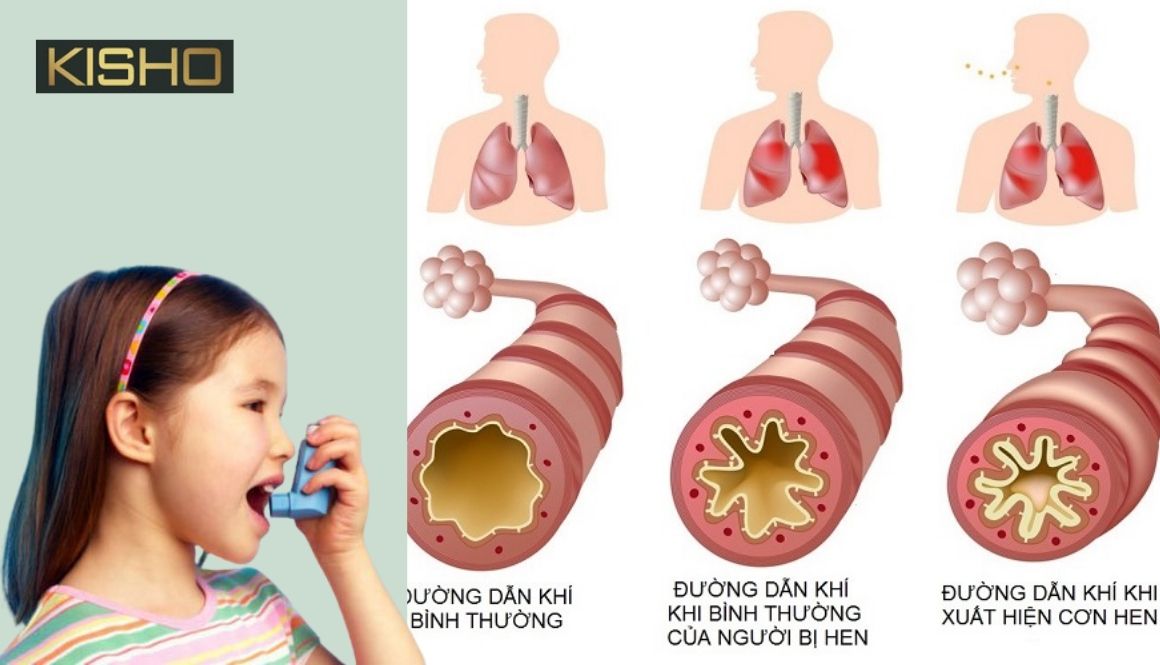 benh-suyen-o-tre-em-co-nguy-hiem-khong (1)
