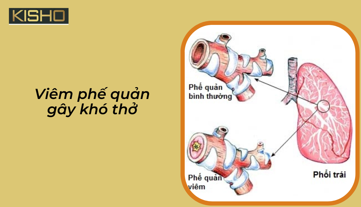 Viêm phế quản gây khó thở